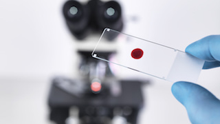 A gloved hand holds up a microscope slide with a blood smear in front of a microscope.