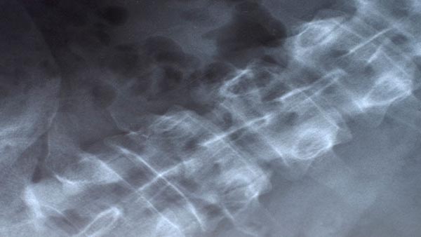 Spinal Fracture