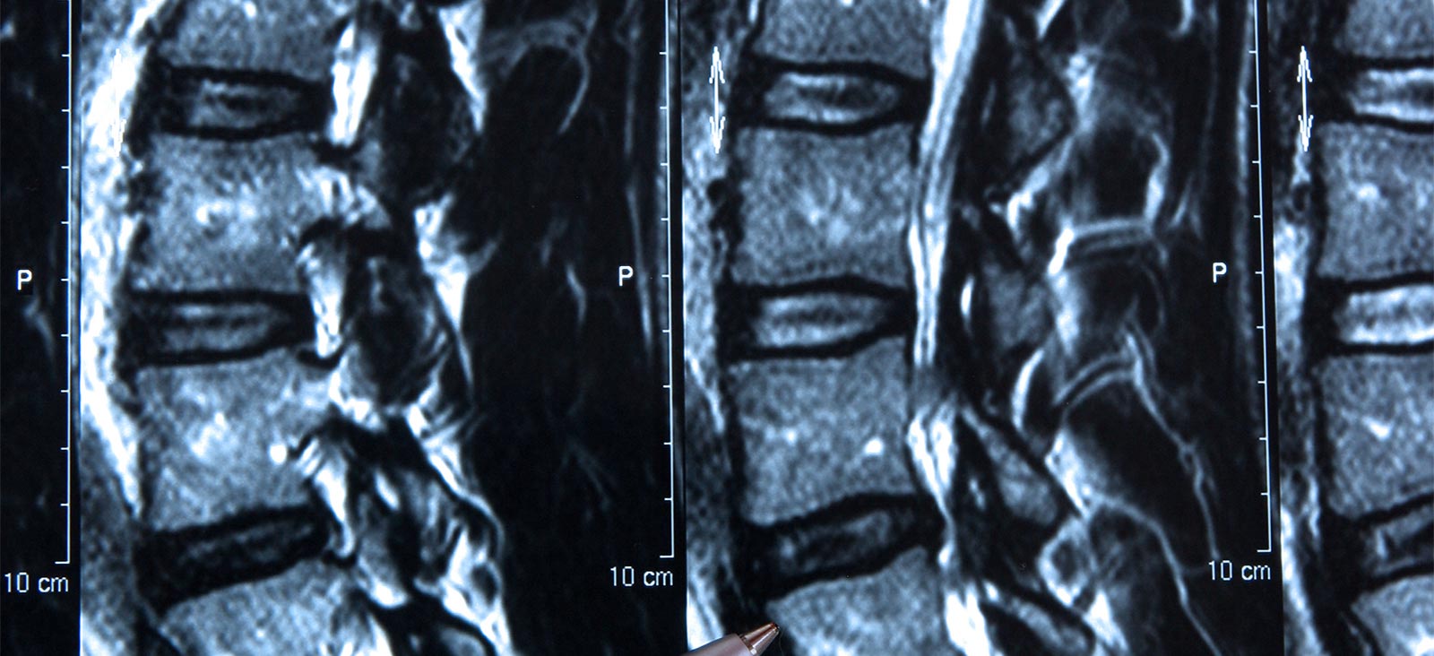 健康・医学 Cancer in the spine Spinal Tumor: What You Need to Know About the Condition
