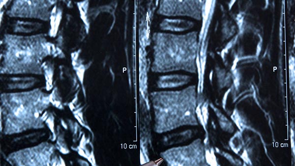 Spinal Tumors