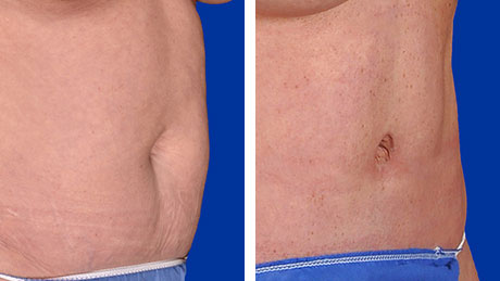 Two images showing an abdomen before and after a procedure, with the after photo displaying a smoother and flatter abdomen.