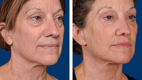 Two side-profile images of a woman before and after a neck lift, showing reduced sagging and a more youthful facial contour.