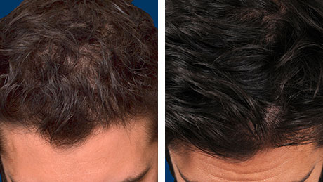 Two images showing the top of a man's head before and after hair restoration treatments, with the after photo displaying noticeably thicker and fuller hair.