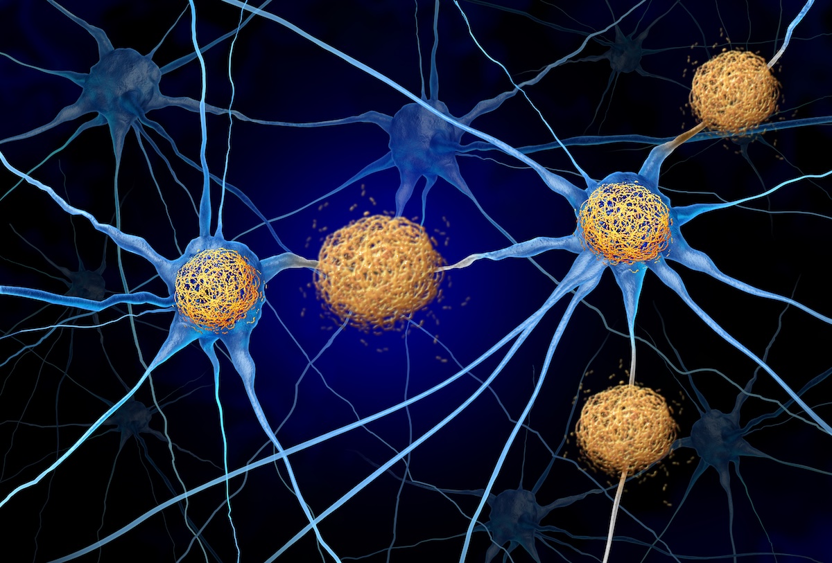 Diagram of tau and amyloid plaque in the brain