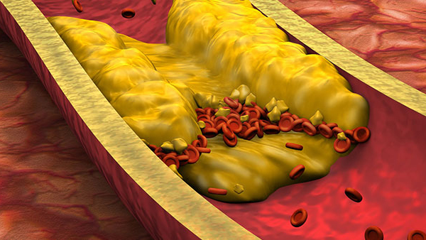 Transient Ischemic Attack