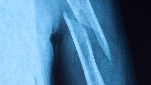 Trauma and Fractures