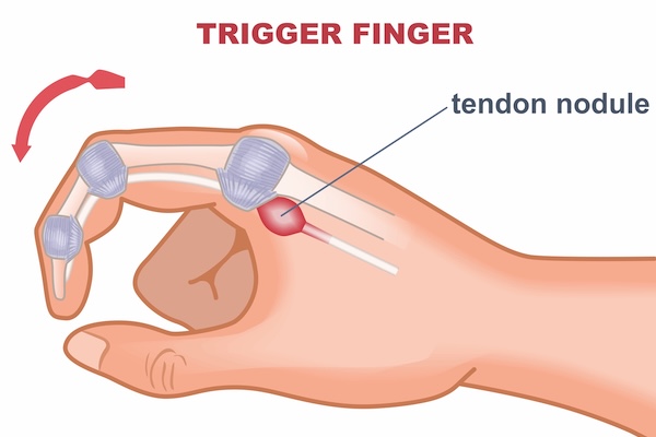 Fixing trigger finger with a fresh approach