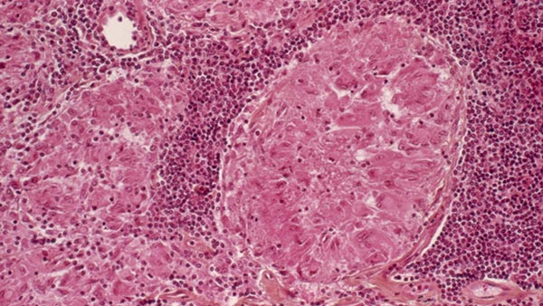 健康・医学 Tuberculosis Tuberculosis - Centre for Lung Health