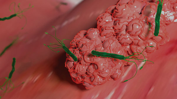 The Consequences of Understaging Gastric Cancer