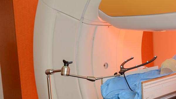 Uterine Fibroid Embolization