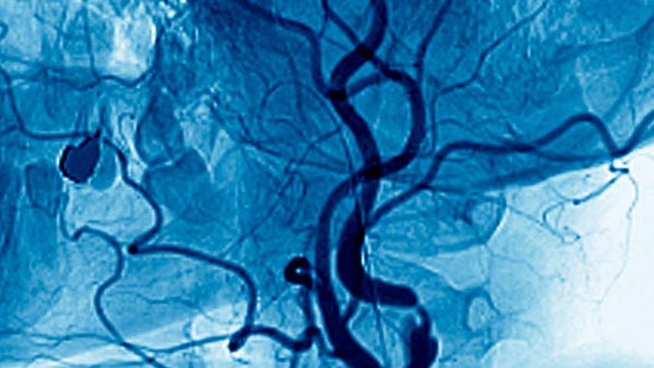 Vascular Malformations