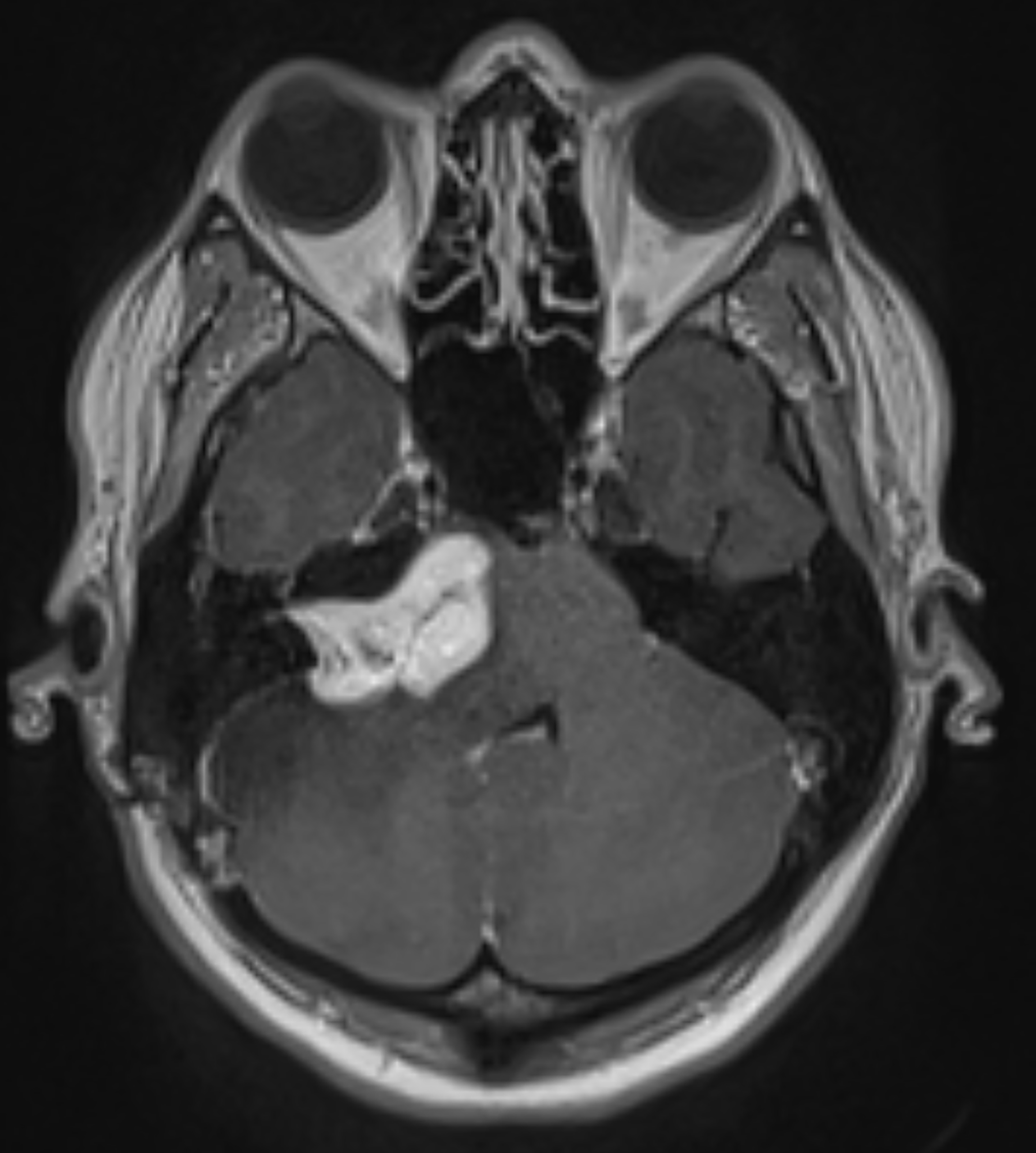 When hearing loss isn’t just about aging: What to know about vestibular schwannomas