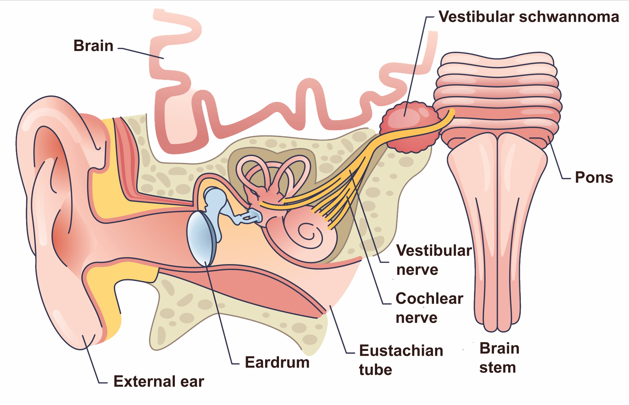 Illustration of anatomy of ear and location of vestibular schwannoma