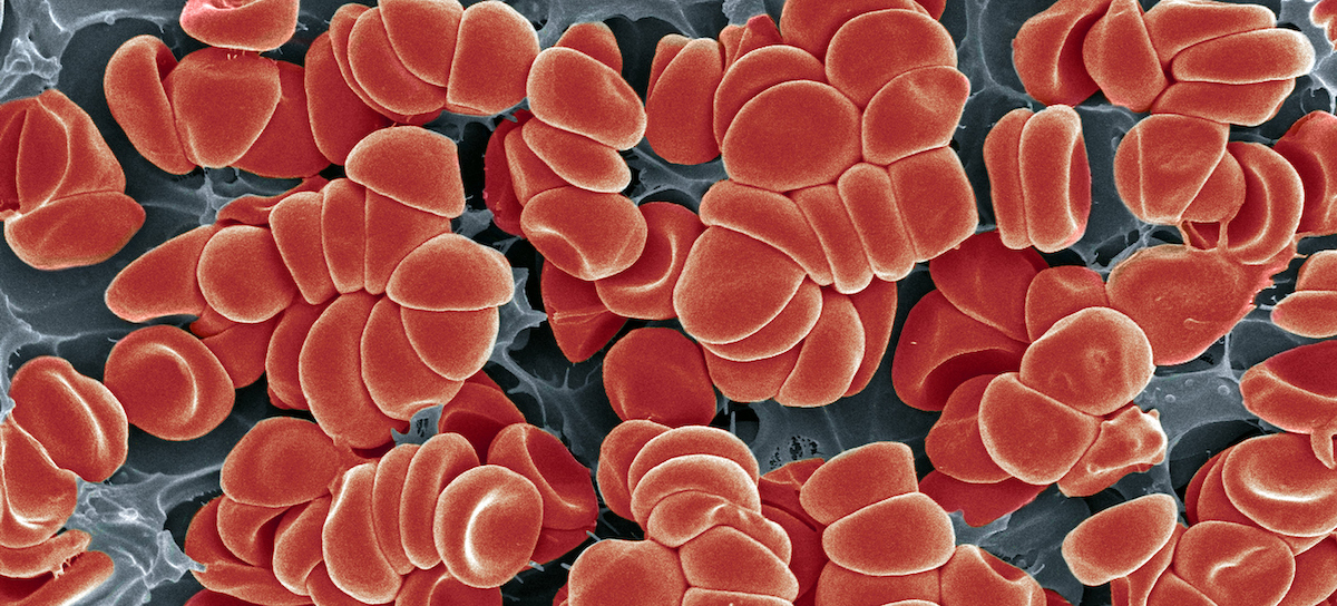 Von Willebrand Disease