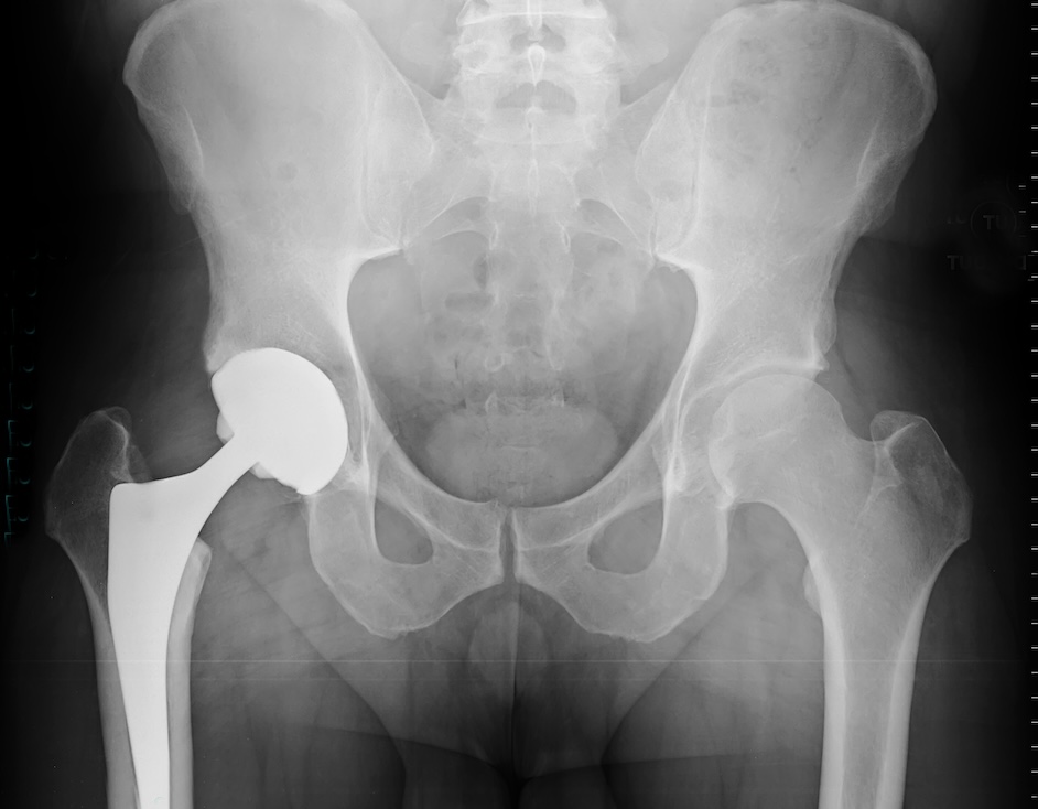 X-ray of total hip arthroplasty