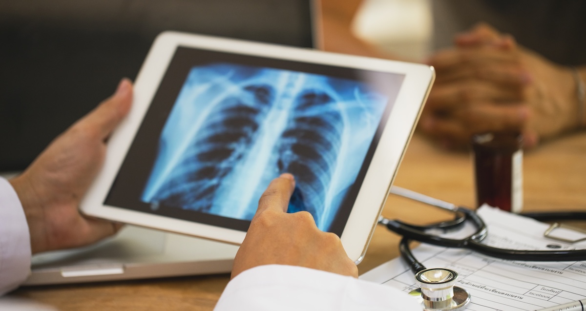 Lung Cancer